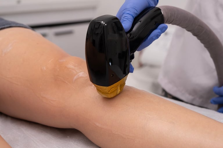 Laser epilation - hair removal procedure on female legs